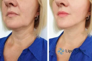 Double chin before and after Hi-Fu treatment 4 Book your double chin treatment Stony Stratford today! We are here to help!