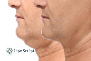 Double chin before and after Hi-Fu treatment 2 Double chin treatment Stony Stratford from Lipo Sculpt - feel more confident today!