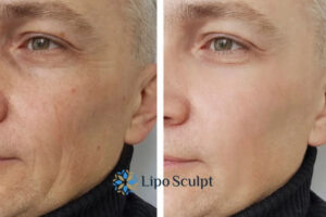 How to Fight Aging Symptoms 3 Fight Aging Symptoms Stony Stratford With HIFU and Morpheus8 Today!