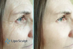 How to Fight Aging Symptoms 2 Do you want to Fight Aging Symptoms Stony Stratford? Contact Lipo Sculpt today!
