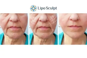 Explaining Morpheus8 And What It Can Do For You 3 Boost your confidence with Morpheus8 Stony Stratford call our team today!
