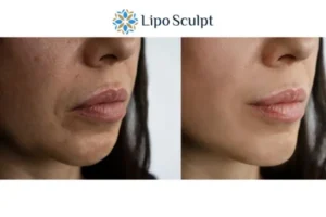 Explaining Morpheus8 And What It Can Do For You 4 Morpheus8 Stony Stratford the best results - call our team today!