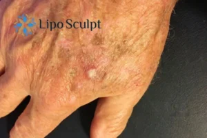 Best Actinic Keratoses Removal 2 Improve your wellbeing and health with Actinic Keratoses Stony Stratford removal.treatment
