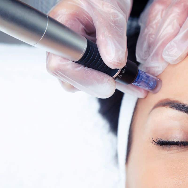 Morpheus8 treatment Stony Stratford from Lipo Sculpt - Book in today!
