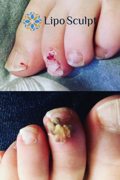 Wart removal customer results from Lipo Sculpt Stony Stratford