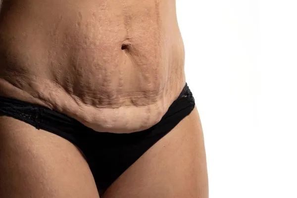 Lost the Weight but Not the Loose Skin? 1 image of womans stomach after weight loss showing loose skin Stony Stratford